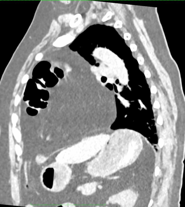 Diaphragmatic Hernia X Ray House